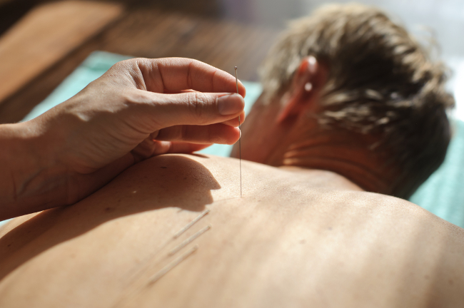 Acupuncture